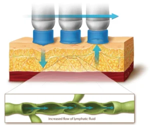 limfna stimulacija i drenaža medcontour multipower luminusestetika