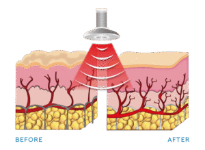 radiofrekvencija medcontour multipower luminusestetika