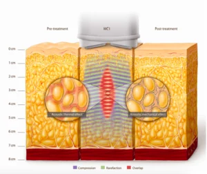 ultrazvuk medcontuor multipower luminusestetika